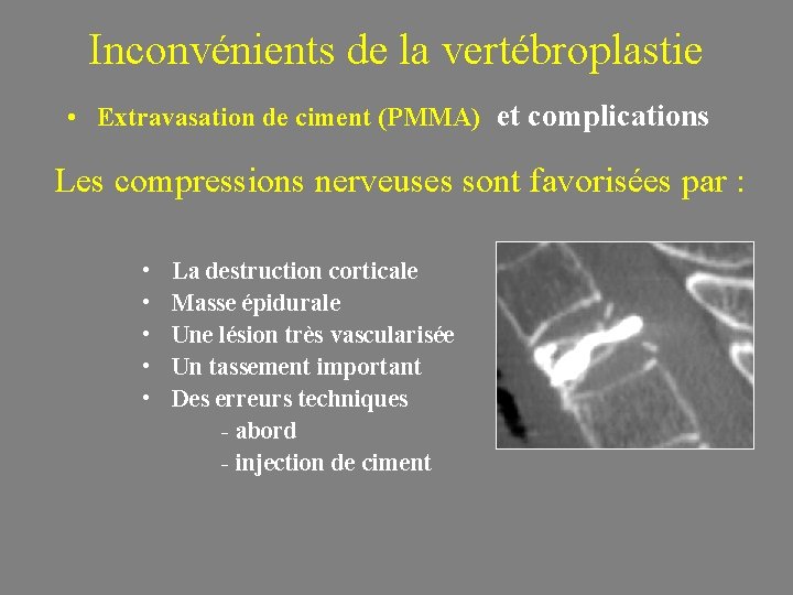 Inconvénients de la vertébroplastie • Extravasation de ciment (PMMA) et complications Les compressions nerveuses