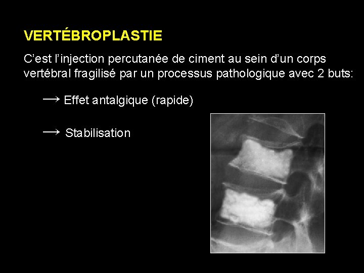 VERTÉBROPLASTIE C’est l’injection percutanée de ciment au sein d’un corps vertébral fragilisé par un