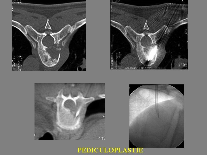 PEDICULOPLASTIE 