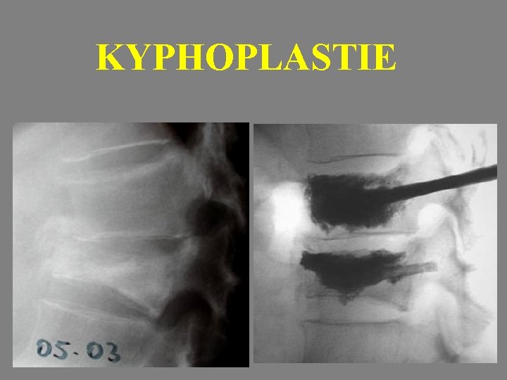 KYPHOPLASTIE 