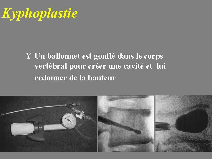 Kyphoplastie Ÿ Un ballonnet est gonflé dans le corps vertébral pour créer une cavité