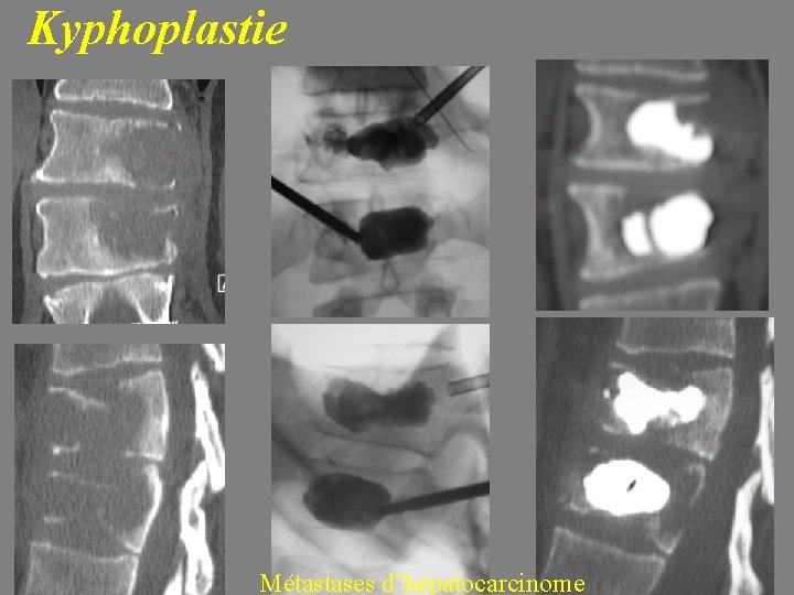 Kyphoplastie Métastases d’hépatocarcinome 