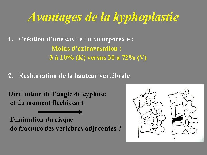 Avantages de la kyphoplastie 1. Création d’une cavité intracorporéale : Moins d’extravasation : 3