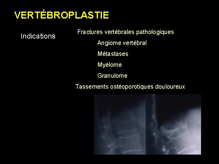 VERTÉBROPLASTIE Indications Fractures vertébrales pathologiques Angiome vertébral Métastases Myélome Granulome Tassements ostéoporotiques douloureux 