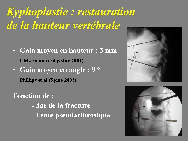 Kyphoplastie : restauration de la hauteur vertébrale • Gain moyen en hauteur : 3