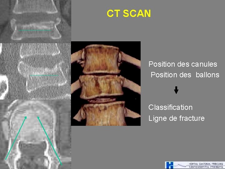 CT SCAN Position des canules Position des ballons Classification Ligne de fracture 