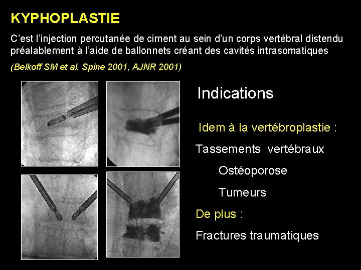 KYPHOPLASTIE C’est l’injection percutanée de ciment au sein d’un corps vertébral distendu préalablement à