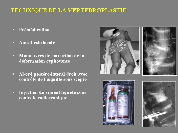 TECHNIQUE DE LA VERTEBROPLASTIE • Prémédication • Anesthésie locale • Manœuvres de correction de