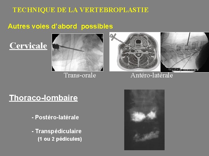 TECHNIQUE DE LA VERTEBROPLASTIE Autres voies d’abord possibles Cervicale Trans-orale Thoraco-lombaire - Postéro-latérale -