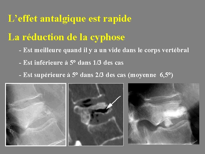 L’effet antalgique est rapide La réduction de la cyphose - Est meilleure quand il