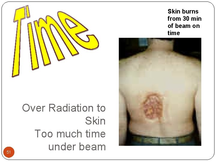 Skin burns from 30 min of beam on time 51 Over Radiation to Skin