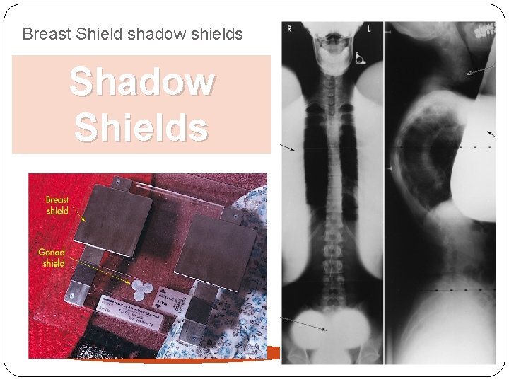 Breast Shield shadow shields Shadow Shields 62 