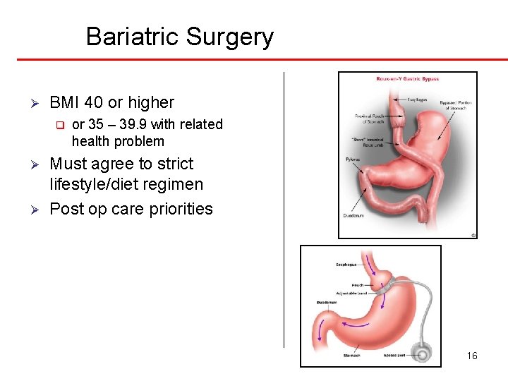 Bariatric Surgery Ø BMI 40 or higher q Ø Ø or 35 – 39.