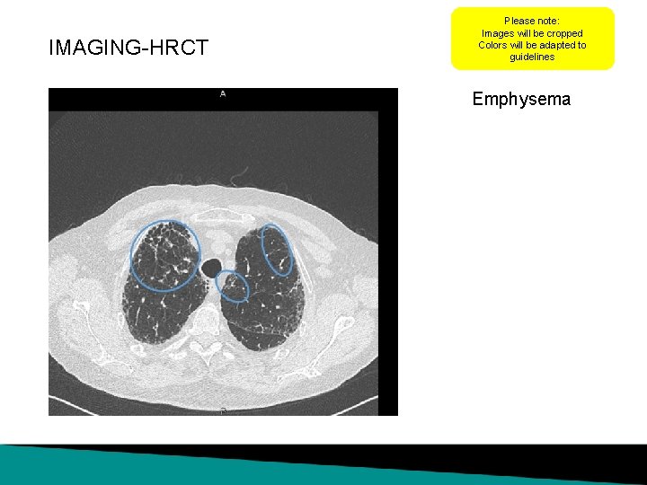 IMAGING-HRCT Please note: Images will be cropped Colors will be adapted to guidelines Emphysema