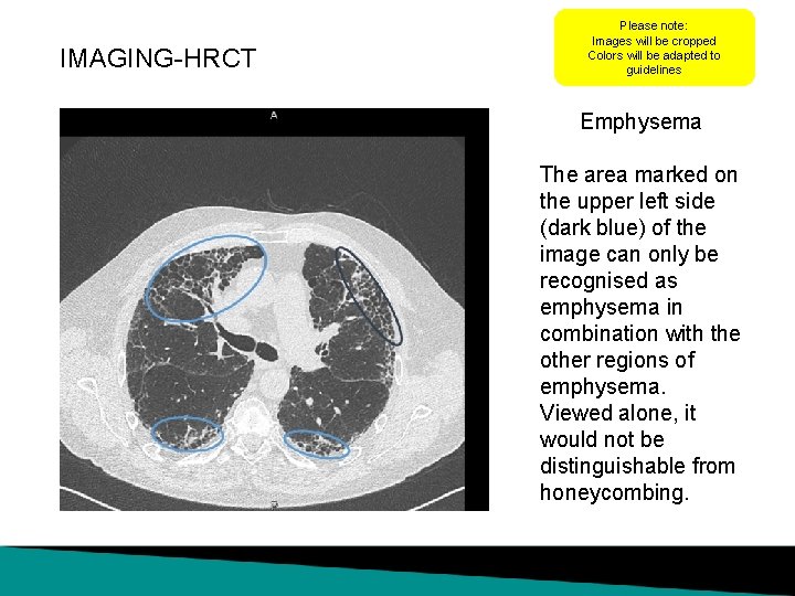 IMAGING-HRCT Please note: Images will be cropped Colors will be adapted to guidelines Emphysema