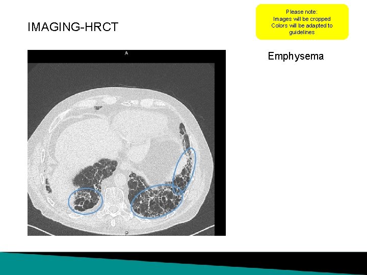 IMAGING-HRCT Please note: Images will be cropped Colors will be adapted to guidelines Emphysema