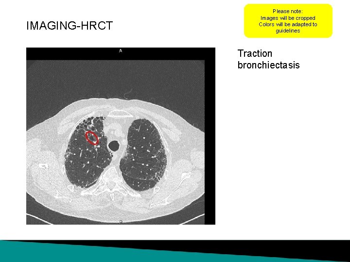 IMAGING-HRCT Please note: Images will be cropped Colors will be adapted to guidelines Traction