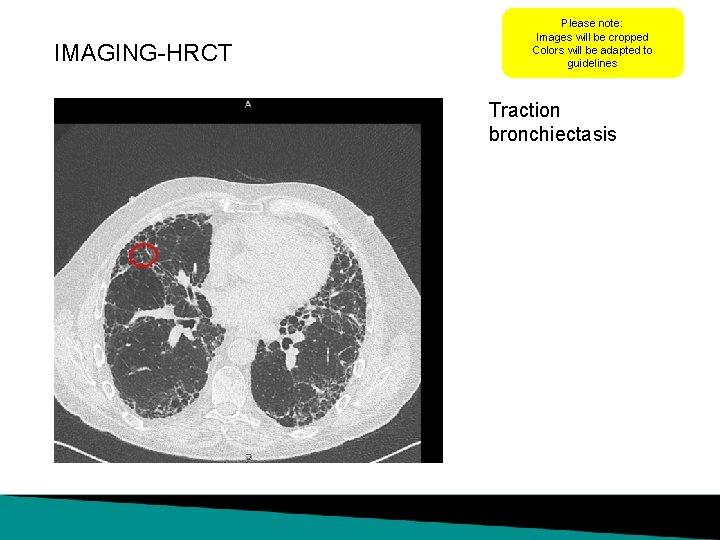 IMAGING-HRCT Please note: Images will be cropped Colors will be adapted to guidelines Traction