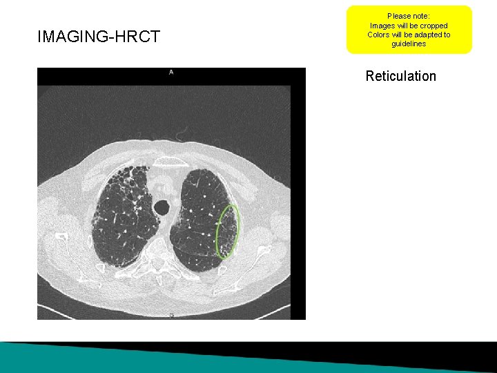 IMAGING-HRCT Please note: Images will be cropped Colors will be adapted to guidelines Reticulation