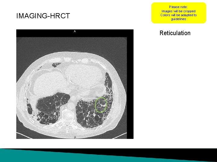 IMAGING-HRCT Please note: Images will be cropped Colors will be adapted to guidelines Reticulation