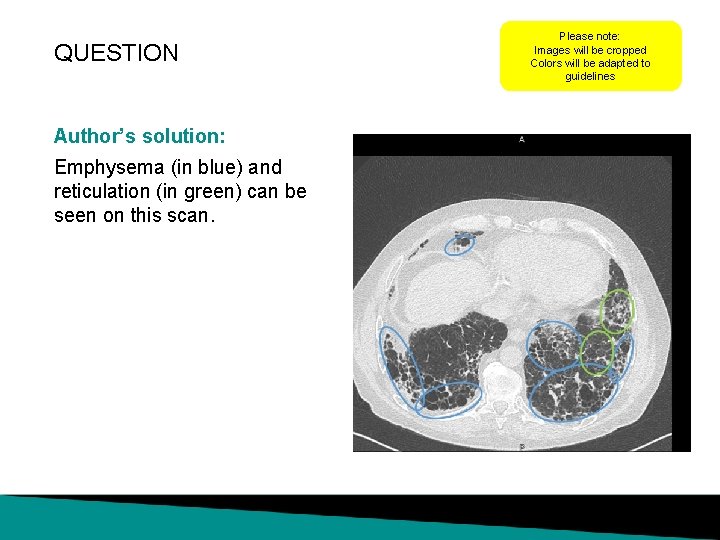 QUESTION Author’s solution: Emphysema (in blue) and reticulation (in green) can be seen on