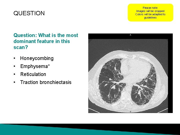 QUESTION Question: What is the most dominant feature in this scan? • Honeycombing •