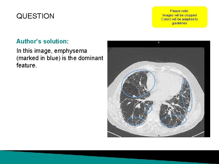 QUESTION Author’s solution: In this image, emphysema (marked in blue) is the dominant feature.