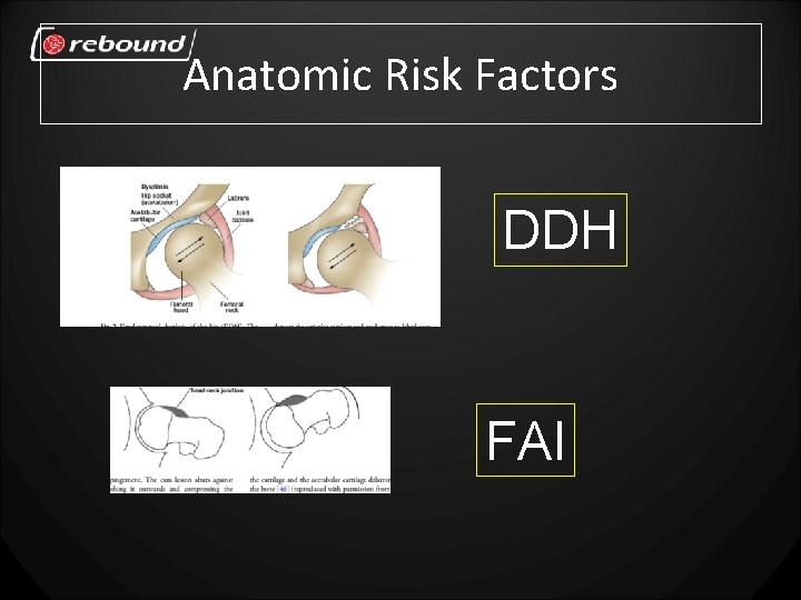 Anatomic Risk Factors DDH FAI 