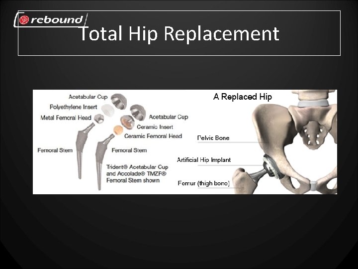 Total Hip Replacement 