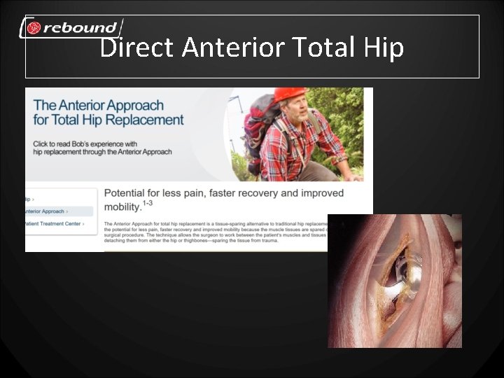 Direct Anterior Total Hip 