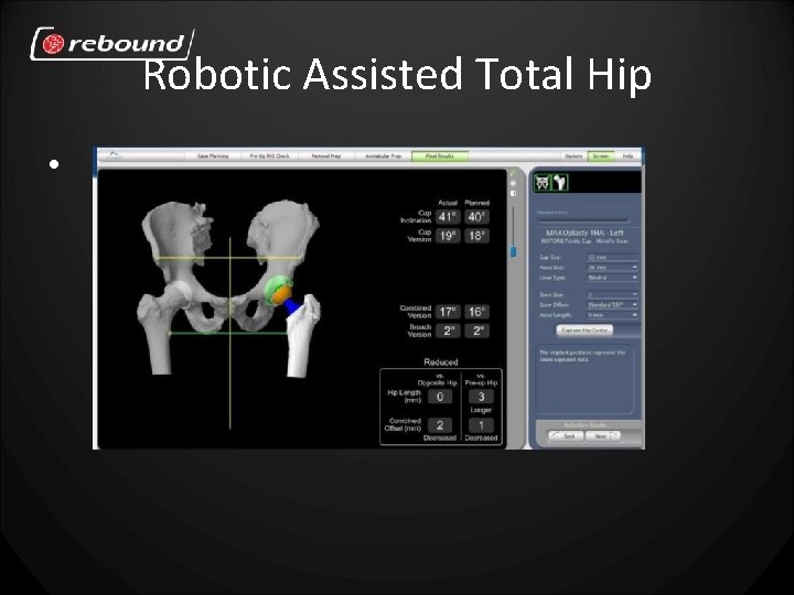 Robotic Assisted Total Hip • 