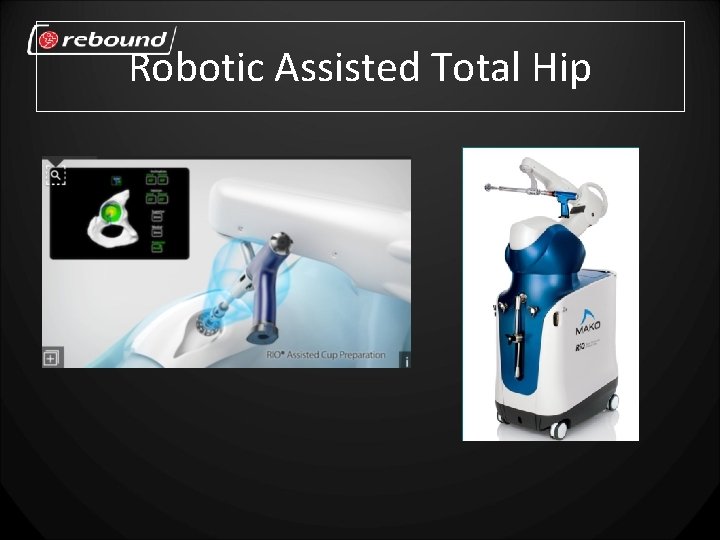 Robotic Assisted Total Hip 