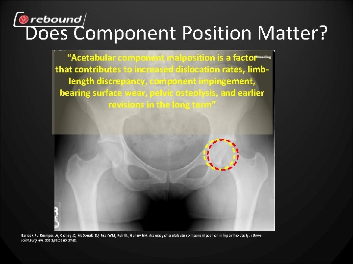 Does Component Position Matter? “Acetabular component malposition is a factor that contributes to increased