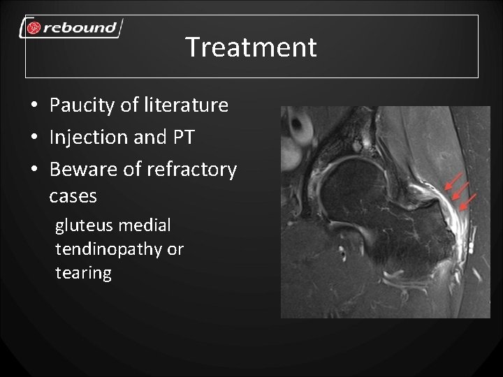 Treatment • Paucity of literature • Injection and PT • Beware of refractory cases