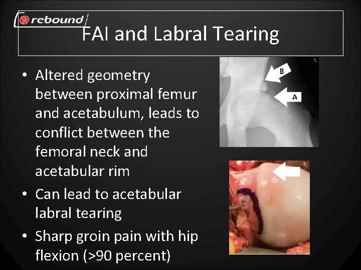 FAI and Labral Tearing • Altered geometry between proximal femur and acetabulum, leads to