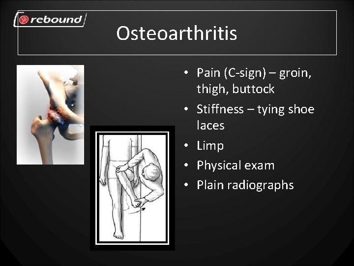 Osteoarthritis • Pain (C-sign) – groin, thigh, buttock • Stiffness – tying shoe laces