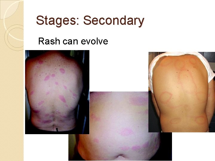 Stages: Secondary Rash can evolve 