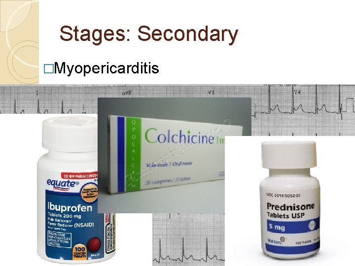 Stages: Secondary �Myopericarditis 