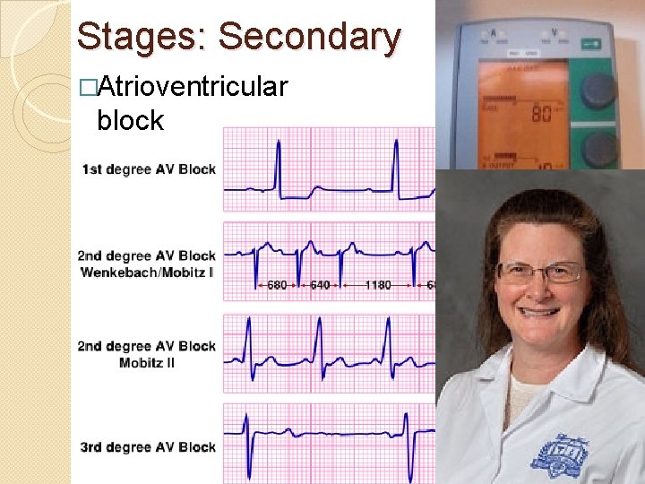 Stages: Secondary �Atrioventricular block 