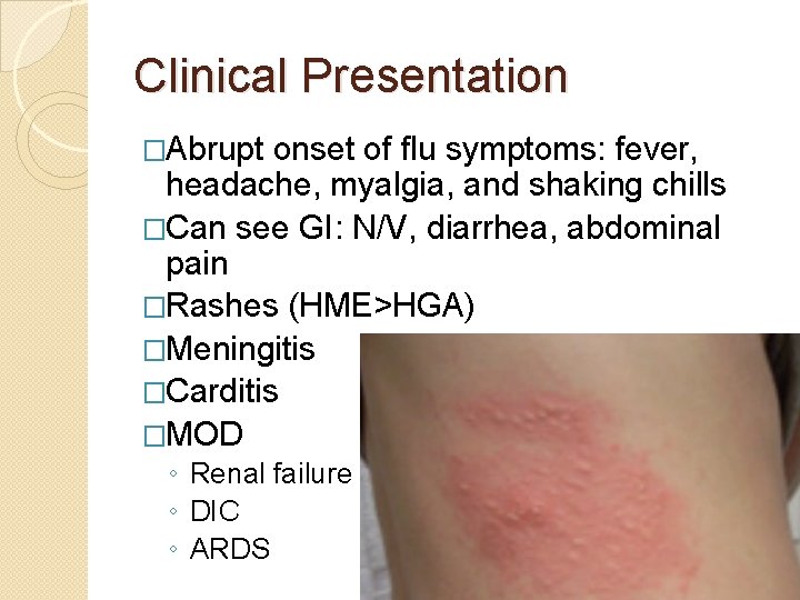 Clinical Presentation �Abrupt onset of flu symptoms: fever, headache, myalgia, and shaking chills �Can