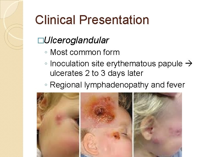 Clinical Presentation �Ulceroglandular ◦ Most common form ◦ Inoculation site erythematous papule ulcerates 2