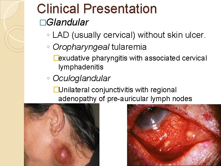 Clinical Presentation �Glandular ◦ LAD (usually cervical) without skin ulcer. ◦ Oropharyngeal tularemia �exudative