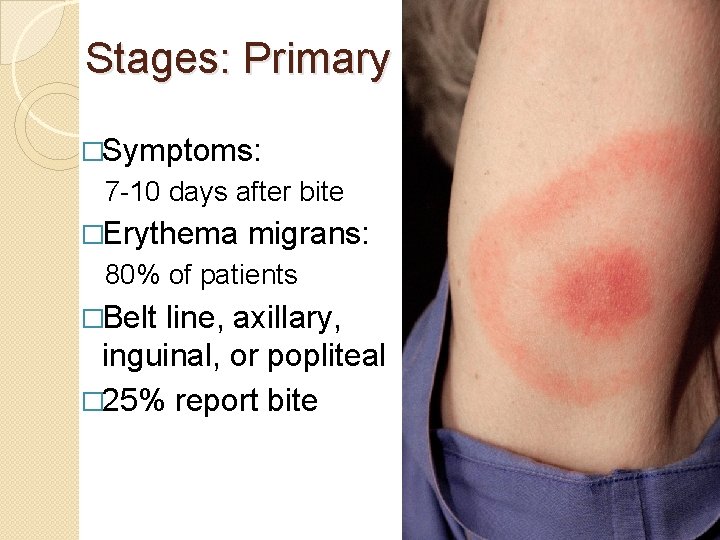 Stages: Primary �Symptoms: 7 -10 days after bite �Erythema migrans: 80% of patients �Belt