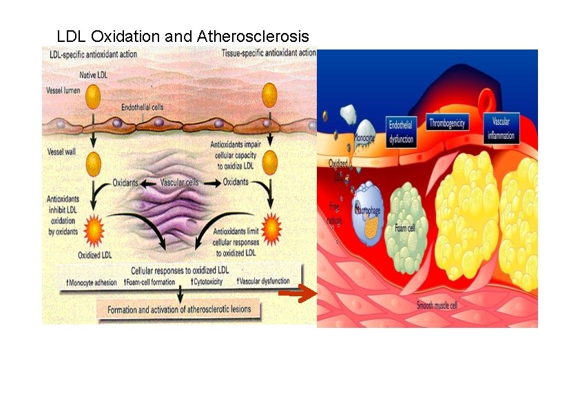 LDL Oxidation and Atherosclerosis 