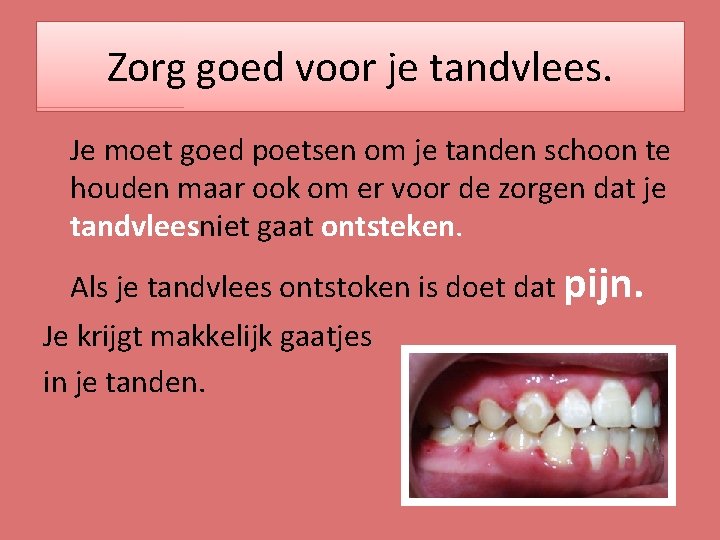 Zorg goed voor je tandvlees. Je moet goed poetsen om je tanden schoon te