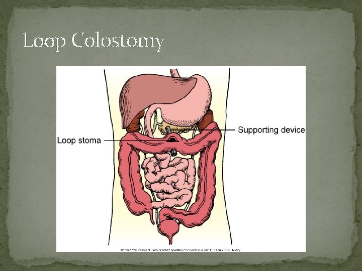 Loop Colostomy 