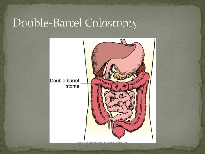 Double-Barrel Colostomy 