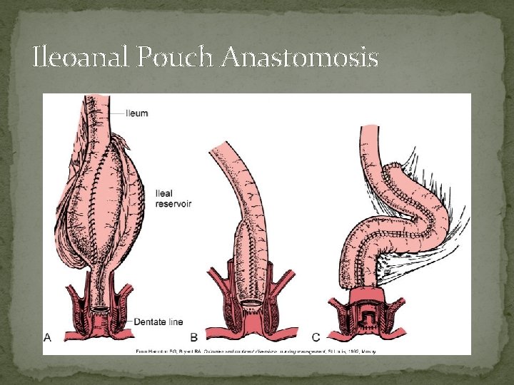 Ileoanal Pouch Anastomosis Ileoanal Pouch Anastomosis