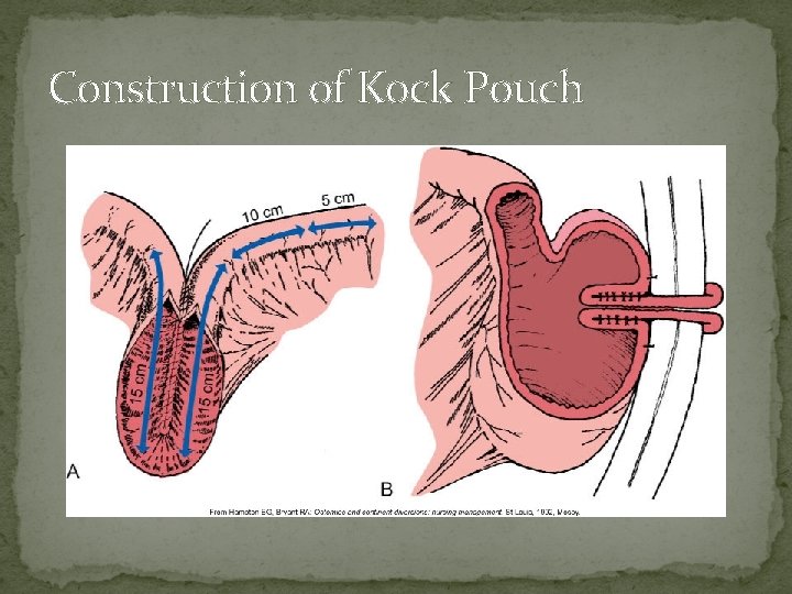 Construction of Kock Pouch 