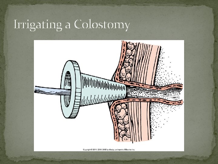 Irrigating a Colostomy 